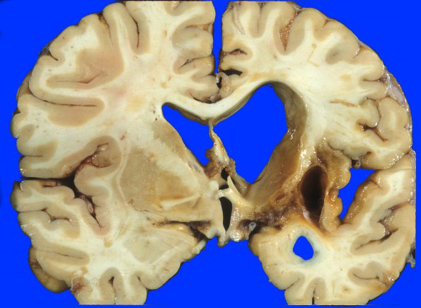 19A1 Infarct, remote, hemorrhagic (Case 19)