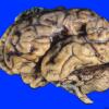 1A1 Infarct, remote (Case 1) 1