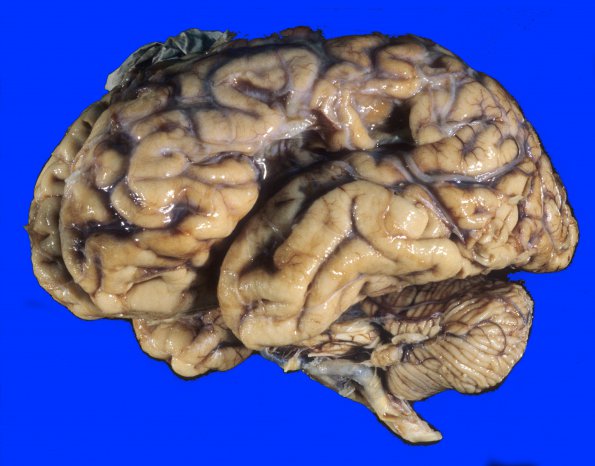 1A1 Infarct, remote (Case 1) 1