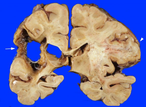 1A2 Infarct, remote (Case 1) 1MCA, copy