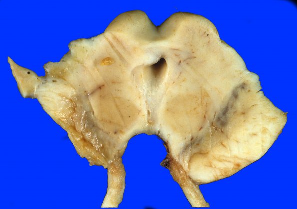 1A3 Infarct, remote (Case 1) 6