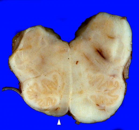 1A4 Infarct, remote (Case 1) 5 copy