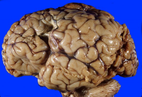 20A1 Infarct (Case 20) 3