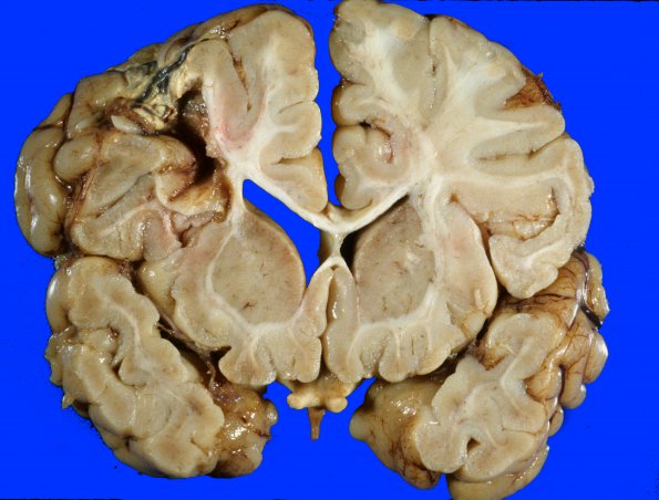 20A3 Infarct (Case 20)