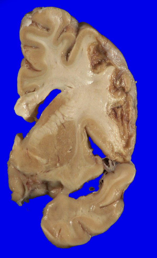 21A2 Infarcts, remote (Case 21) _3