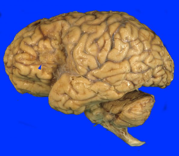 2A1 Infarct, remote, (Case 2) 1 copy