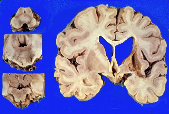 3 Infarct, old (Case 3) gross