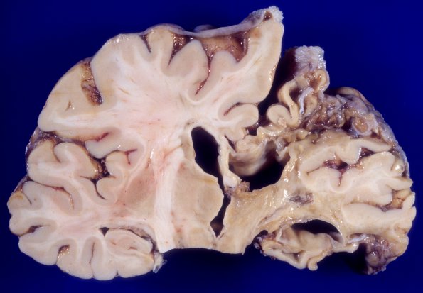 4A1 Infarct, remote (Case 4)