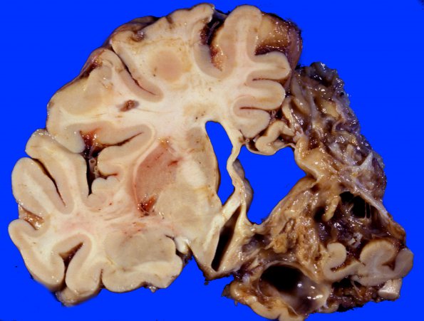 4A2 Infarct, Old 1g (Case 4)