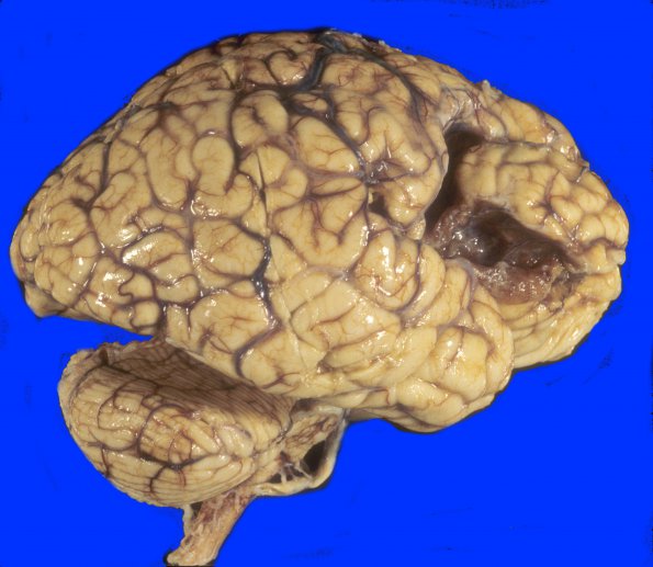 5A1 Infarct, remote (15-20 yrs) (Case 5) 3