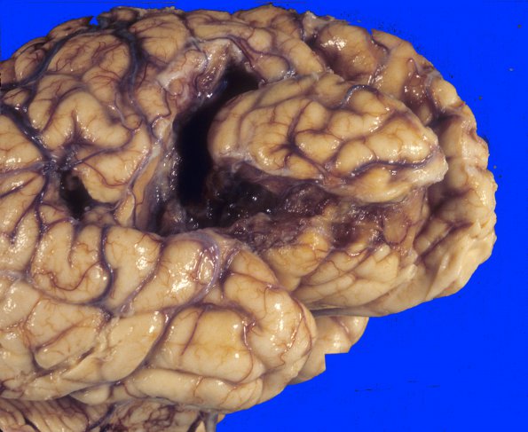 5A2 Infarct, remote (15-20 yrs) (Case 5) 2