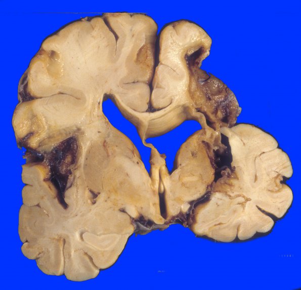 5A3 Infarct, remote (15-20 yrs) (Case 5) 1