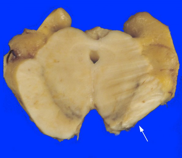 5A4 Infarct, remote (15-20 yrs) (Case 5) 4 copy