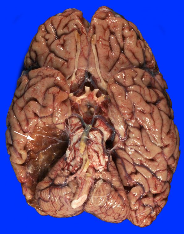 6A1 Infarct, remote (Case 6) Gross_1 copy