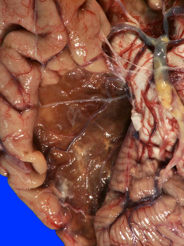 6A2 Infarct, remote (Case 6) Gross_2