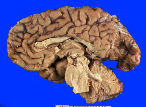 6A3 Infarct, remote (Case 6) Gross_4