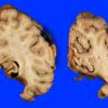 6A4 Infarct, remote (Case 6) Gross_8