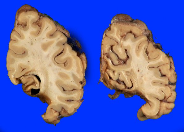 6A4 Infarct, remote (Case 6) Gross_8