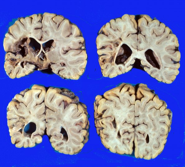 7 Infarct, old (Case 7)