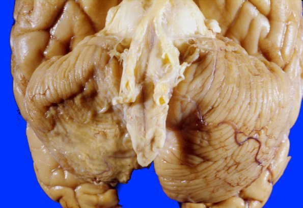 8A1 Infarct, Old, PICA (Case 8) C