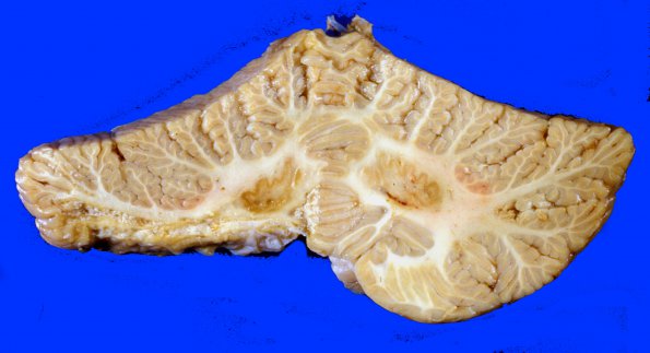 8A2 Infarct, Old, PICA (Case 8) D