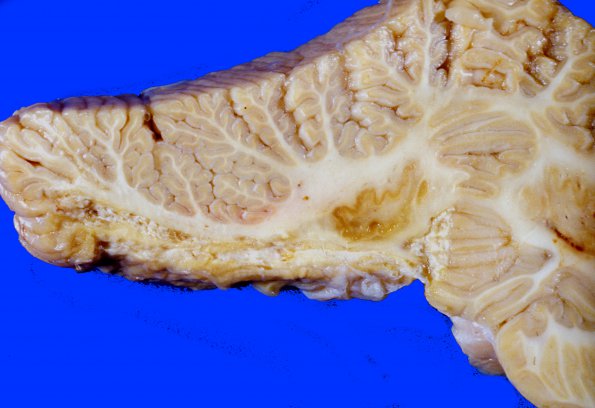 8A3 Infarct, Old, PICA (Case 8) A