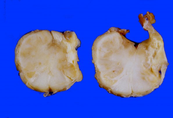 8A4 Infarct, Old, PICA (Case 8) B