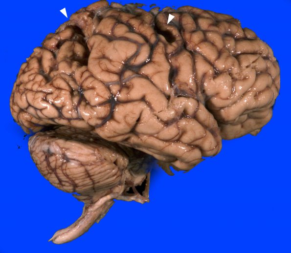 9A1 Infarct, remote (25 years, Case 9)_3 copy