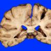 9A2 Infarct, remote (25 years, Case 9)_5