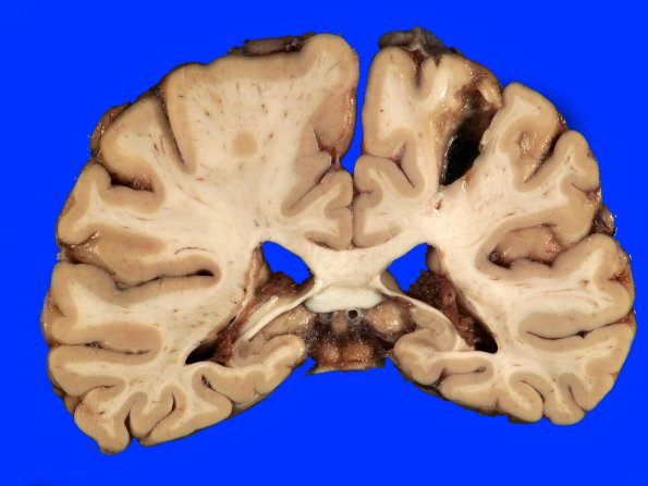 9A2 Infarct, remote (25 years, Case 9)_5