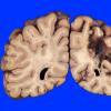 9A3 Infarct, remote (25 years, Case 9)_7