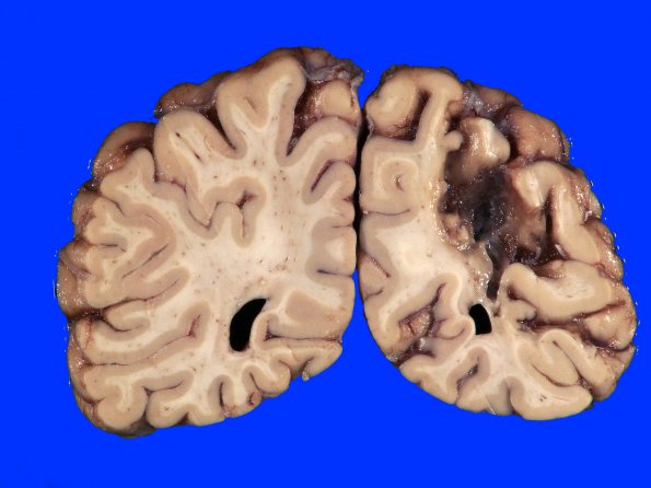 9A3 Infarct, remote (25 years, Case 9)_7