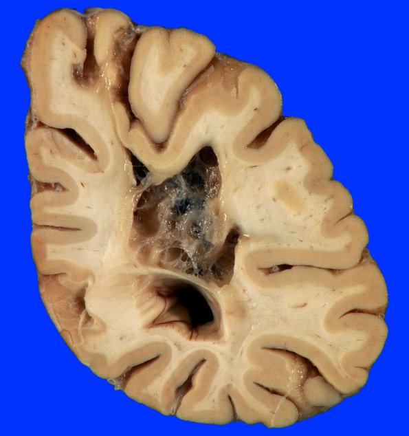 9A4 Infarct, remote (25 years, Case 9)_9