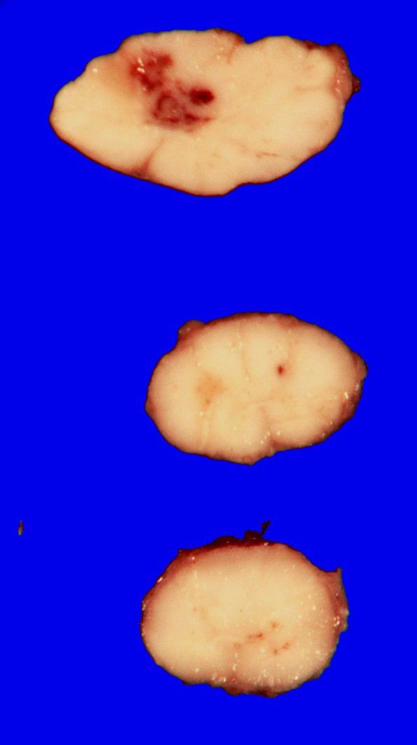 10A1 Infarct, spinal cord, CNS non-perfusion (Case 10) A