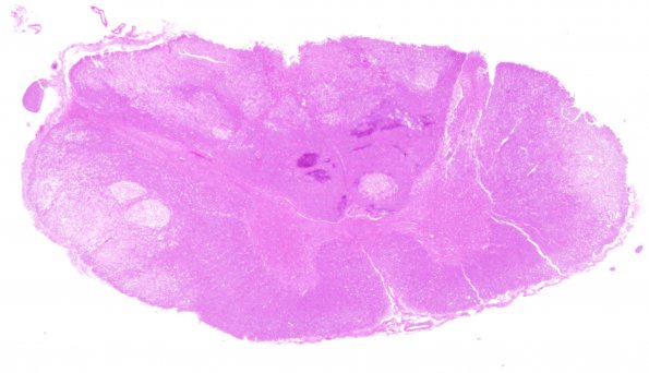 10B1 Infarct, spinal cord, CNS non-perfusion (Case 10) H&E SC