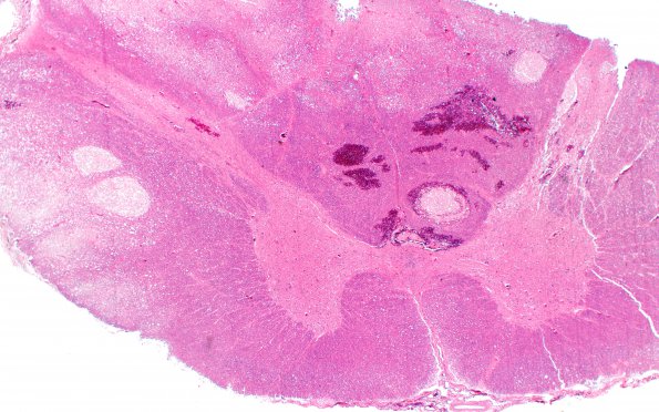 10B2 Infarct, spinal cord, CNS non-perfusion (Case 10) H&E 2X