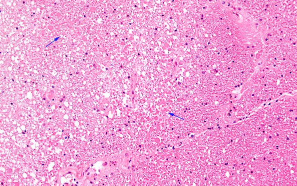 10B3 Infarct, spinal cord, CNS non-perfusion (Case 10) H&E copy (2)