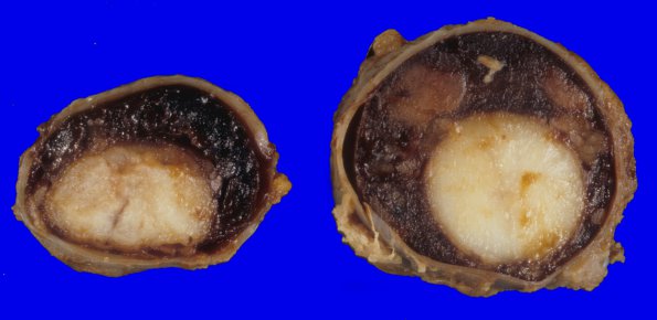 11A2 Infarction, spinal cord, SAH SP Burkitt Lymphoma Rx (Case 11) 2