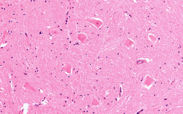 11B3 Infarction, spinal cord, SAH SP Burkitt Lymphoma Rx (Case 11) 20X