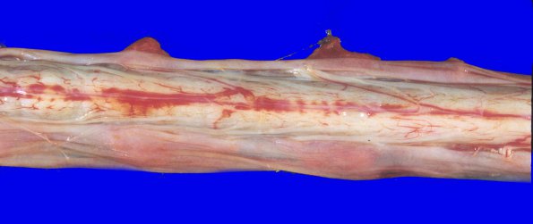 1A1 Infarct, Aortic aneurysm repair (Case 1) 2