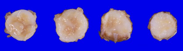 1A2 Infarct, Aortic aneurysm repair (Case 1) 1