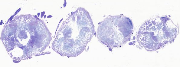 1B3 Infarct, Aortic aneurysm repair (Case 1) N14 LFB-PAS WM