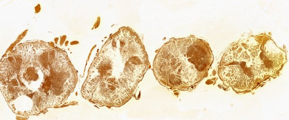 1B4 Infarct, Aortic aneurysm repair (Case 1) N14 Biels WM