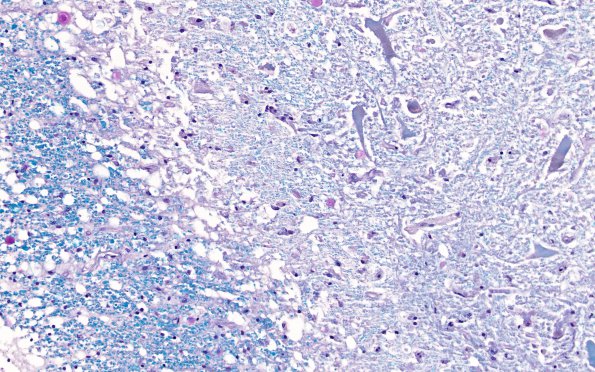 1C5 Infarct, Aortic aneurysm repair (Case 1) N15 LFB-PAS 20X