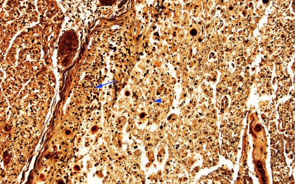 1C7 Infarct, Aortic aneurysm repair (Case 1) N15 Biels 20X copy