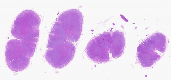 1D1 Infarct, Aortic aneurysm repair (Case 1) N13 H&E WM