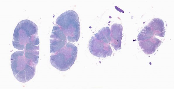 1D2 Infarct, Aortic aneurysm repair (Case 1) N13 LFB-PAS WM