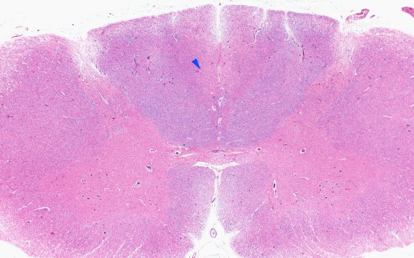 1E1 Infarct, Aortic aneurysm repair (Case 1) N13 H&E 2X copy