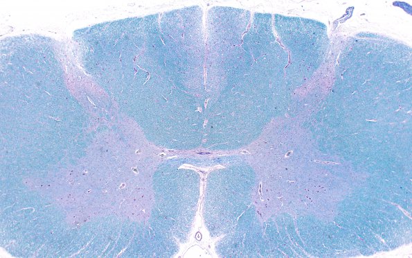 1E2 Infarct, Aortic aneurysm repair (Case 1) N13 LFB-PAS 2X 1