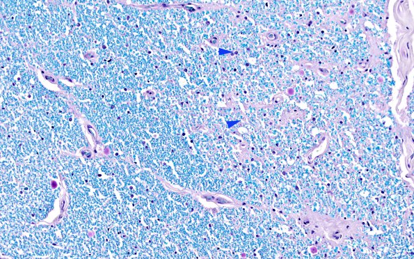 1F2 Infarct, Aortic aneurysm repair (Case 1) N13 LFB-PAS 20X copy